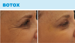 Botox - Before & After Photos