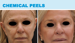 Chemcial Peels - Before & After Photos