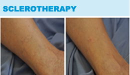 Sclerotherapy - Before & After Photos