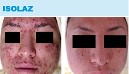 Isolaz - Before & After Photos